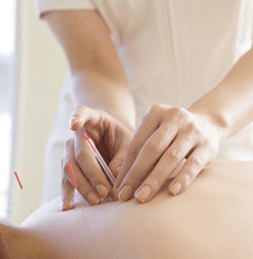 Acupuncture